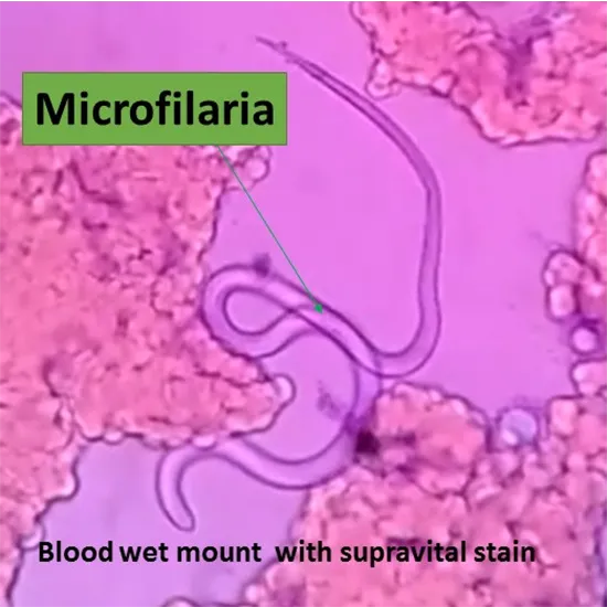 microfilaria detection test
